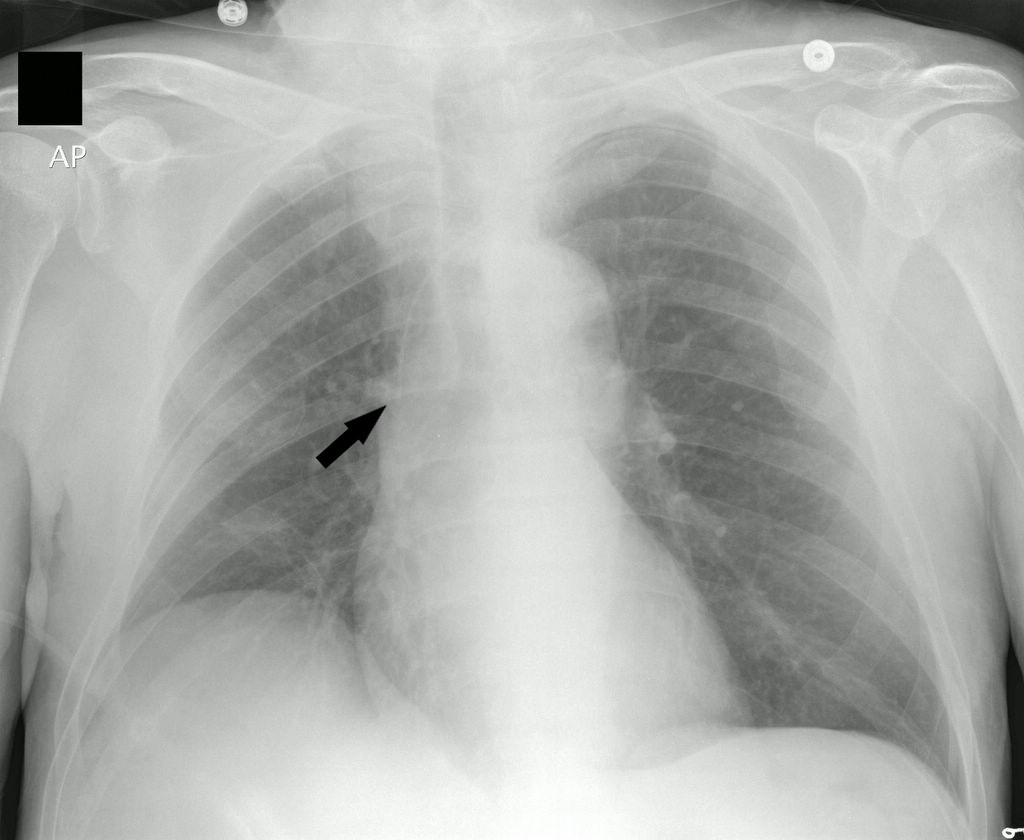 Chest x-ray picc line