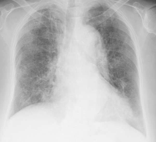 Chest x-ray pneumocystis pneumonia