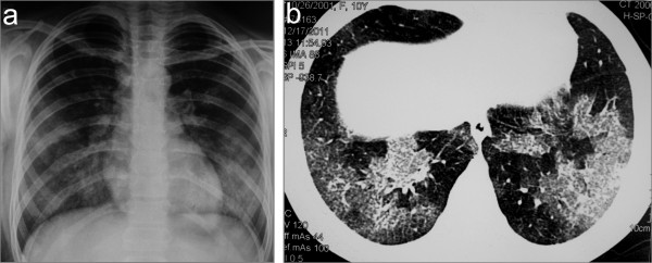 Chest imaging in a child with concurrent goodpasture syndrome and anca vasculitis