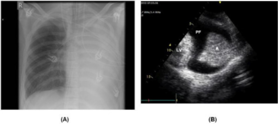 Chest x-ray and ultrasound of atelectasis