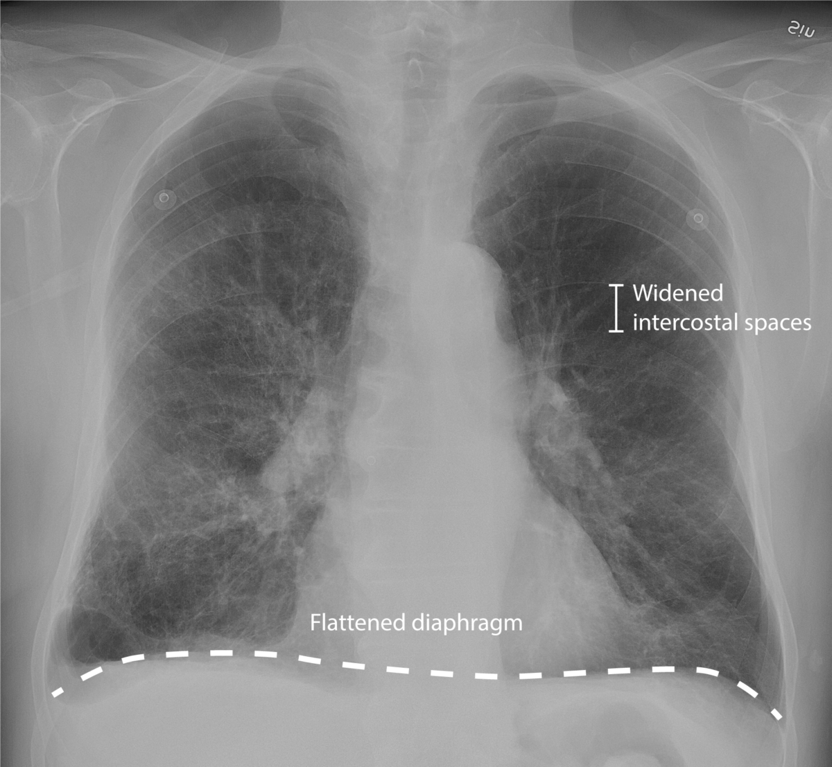 Chest x-ray of chronic obstructive pulmonary disease (copd)