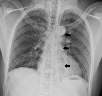 Chest x-ray of pneumomediastinum and left-sided pleural effusion