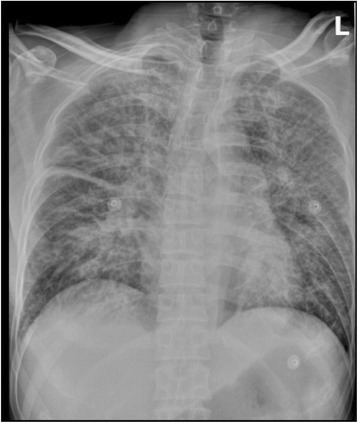 Chest x-ray pneumonic plague