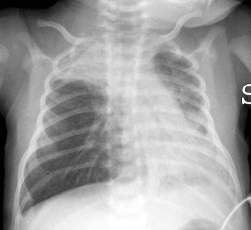 Radiografía de tórax bronquiolitis por virus sincitial respiratorio