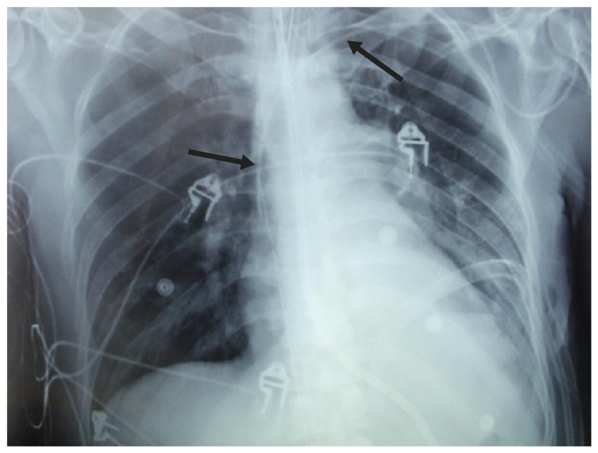 Chest x-ray showing an endotracheal tube