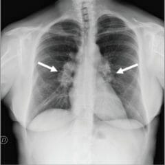 Chest X-ray showing bilateral hilar lymphadenopathy in a patient with CGD