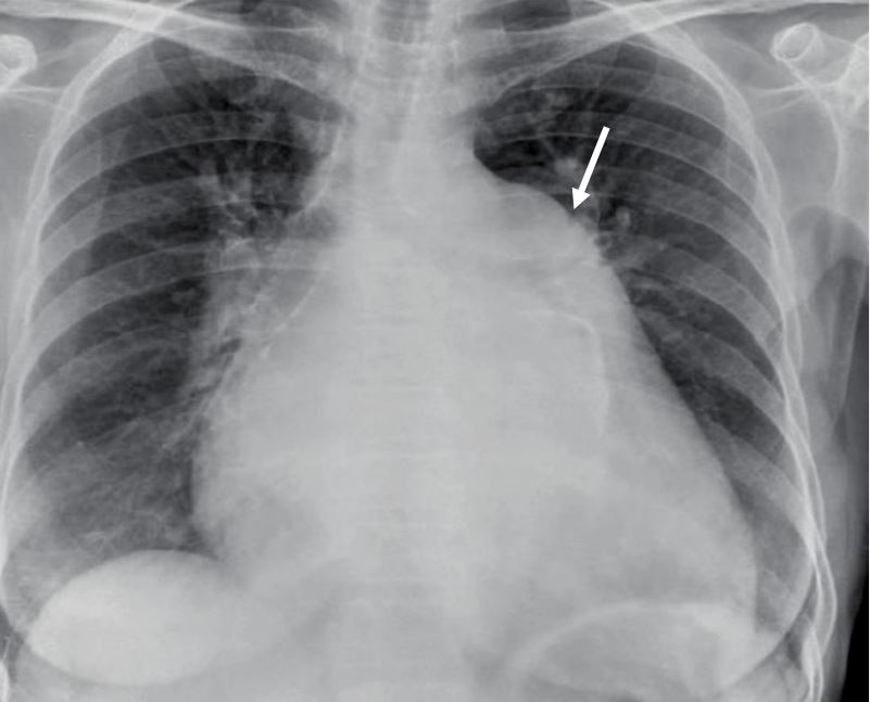 Chest x-ray showing left atrial enlargement