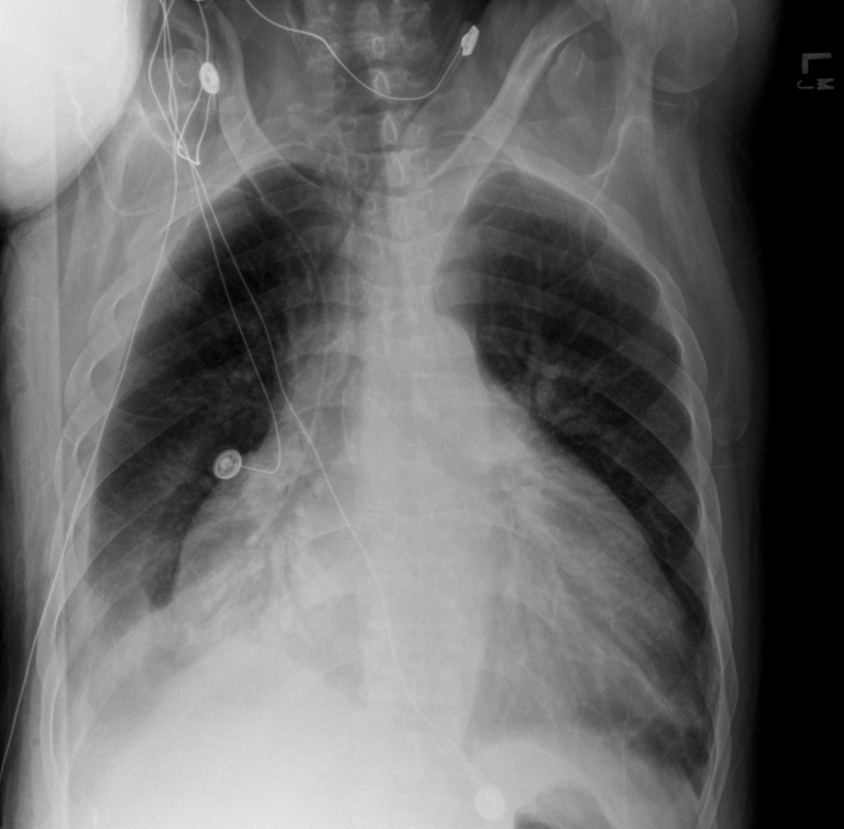 Chest x-ray showing pericardial effusion