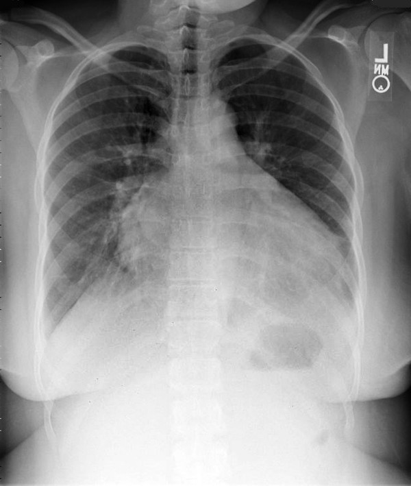 Chest x-ray showing prominent cardiomegaly and bibasilar interstitial markings
