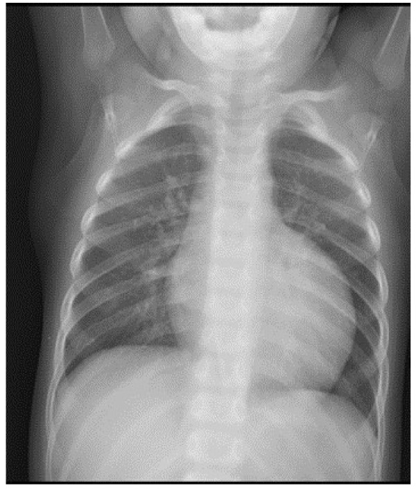 Chest x-ray showing severe cardiomegaly