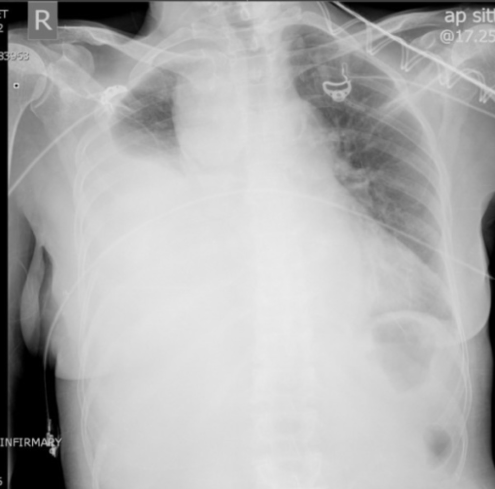Chest x-ray shows massive right hemothorax