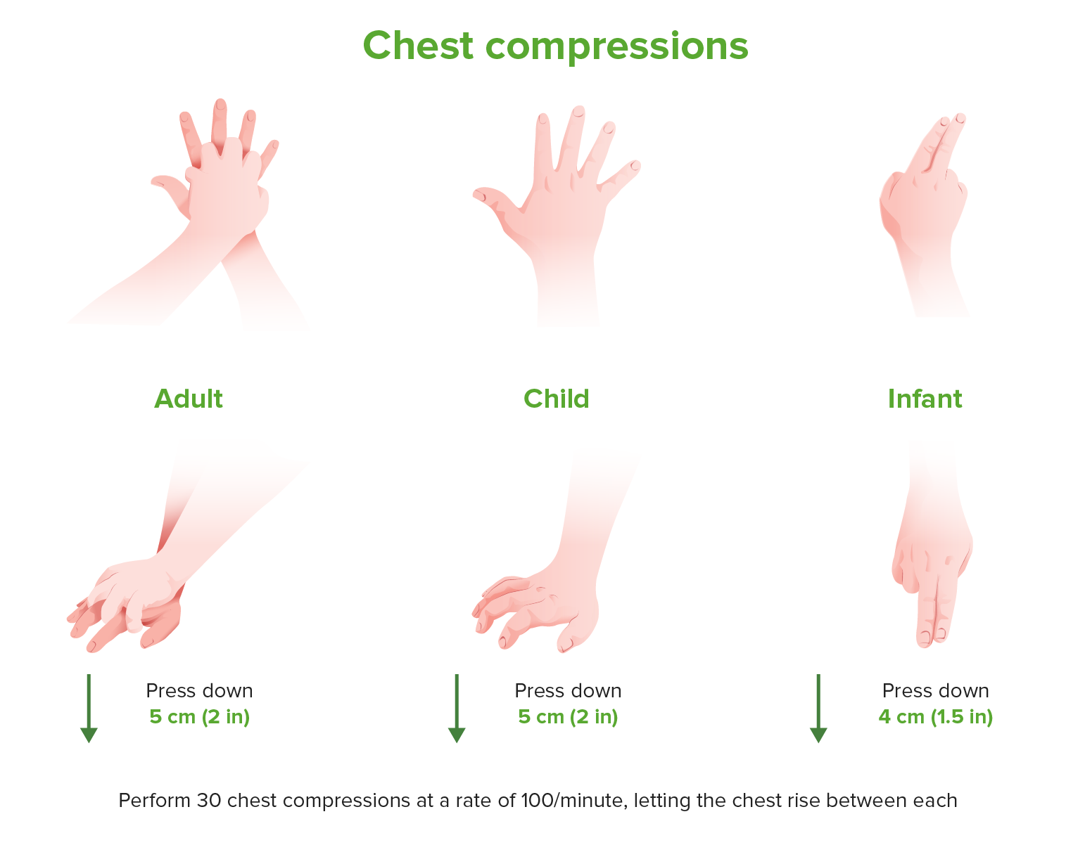 Figure: Chest compression in infants and children - MSD Manual