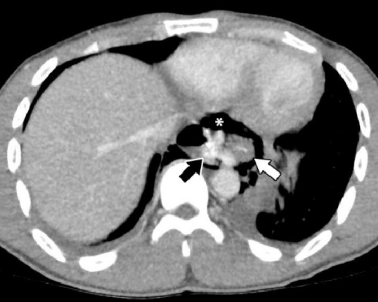 Chest computed tomography (ct) scan revealing a distal esophageal rupture