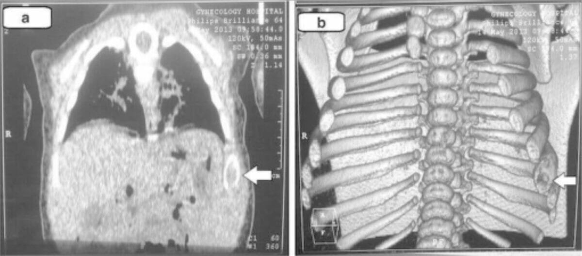 Descobertas de tomografia computorizada do tórax na histiocitose de células de langerhans