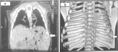 Histiocitose de Células de Langerhans Concise Medical Knowledge