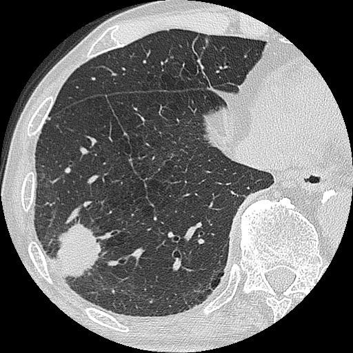 Chest ct scan showing a solid mass with spiculation
