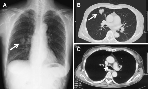 Chest radiograph and computed tomography scan lung cancer