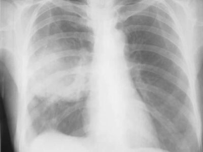 Lung Cancer Screening | Concise Medical Knowledge