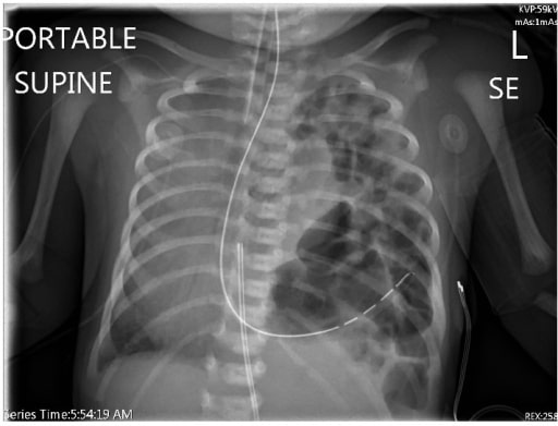 Chest radiograph diaphragmatic hernia