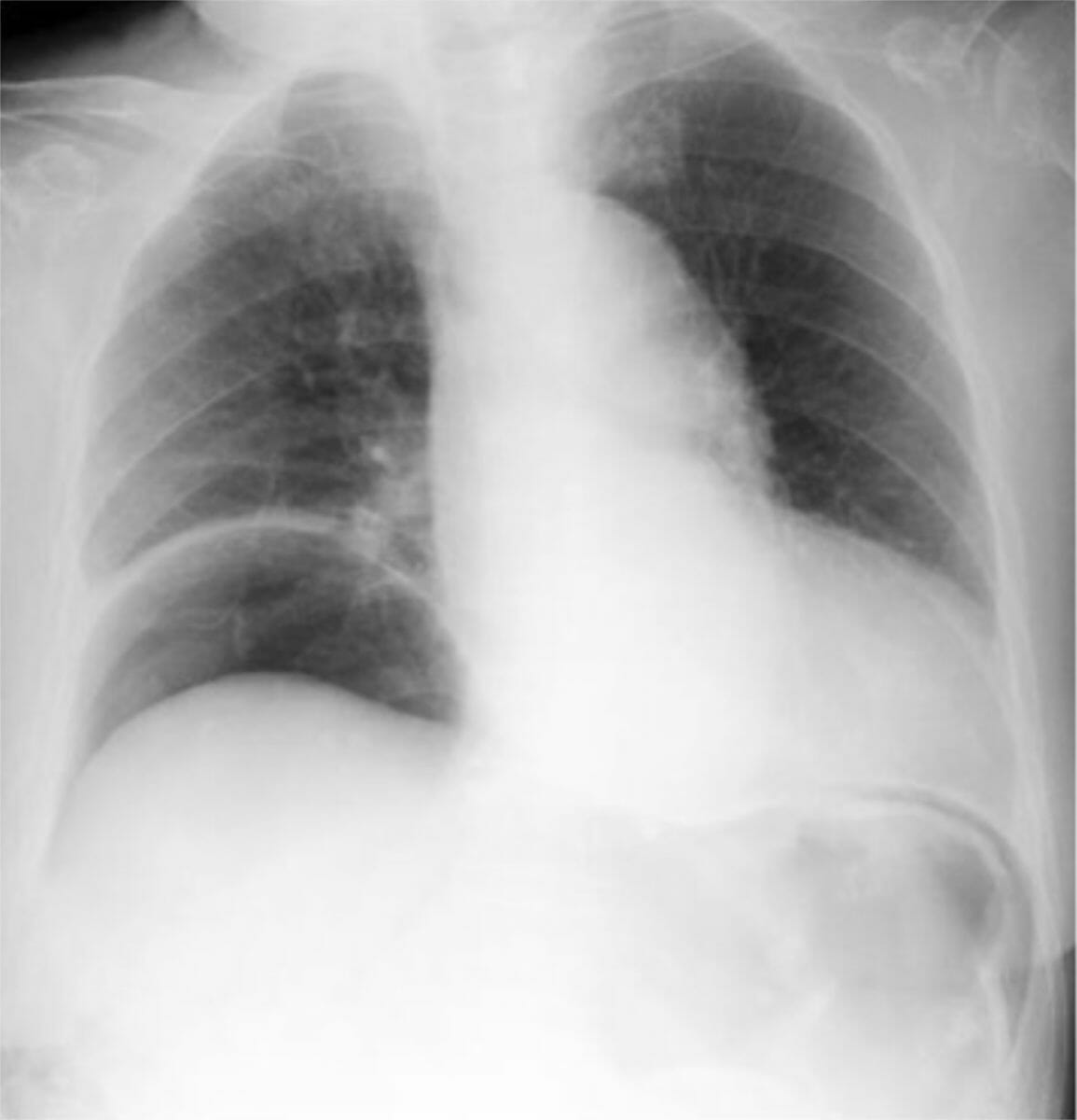 Chest radiograph in the sitting posture showing free gas