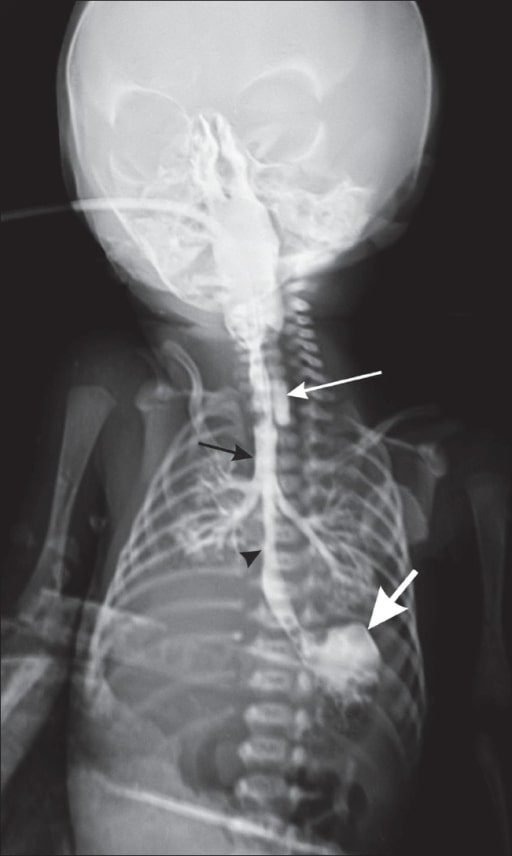 Chest radiograph of a baby with esophageal atresia