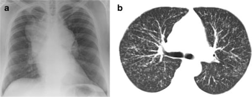Chest radiograph showing massive hilar and mediastinal lymphadenopathy