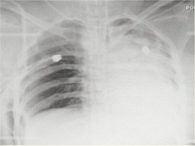 Chest radiograph with ribs fractures and pneumothorax