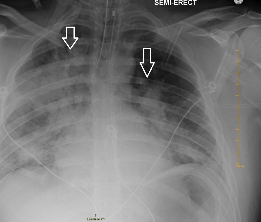 Chest radiography demonstrating bilateral hilar opacities