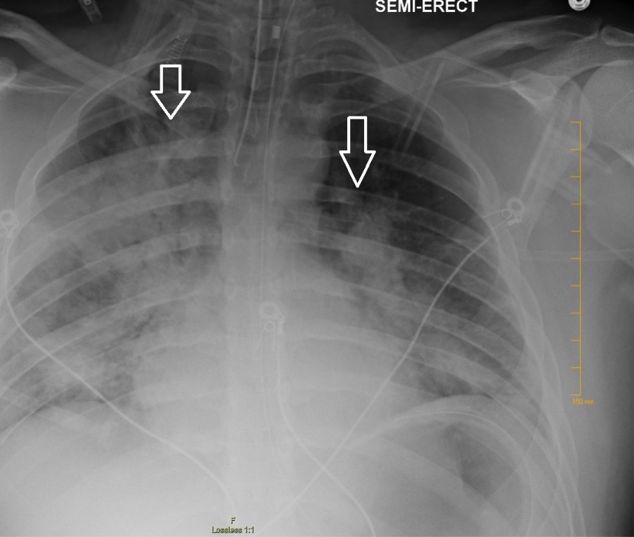 Ards Chest X Ray - lusomentepalavras