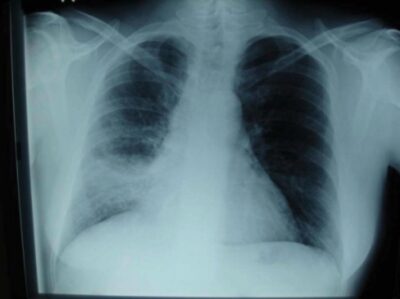 Chest radiography of lower lobe pneumonia