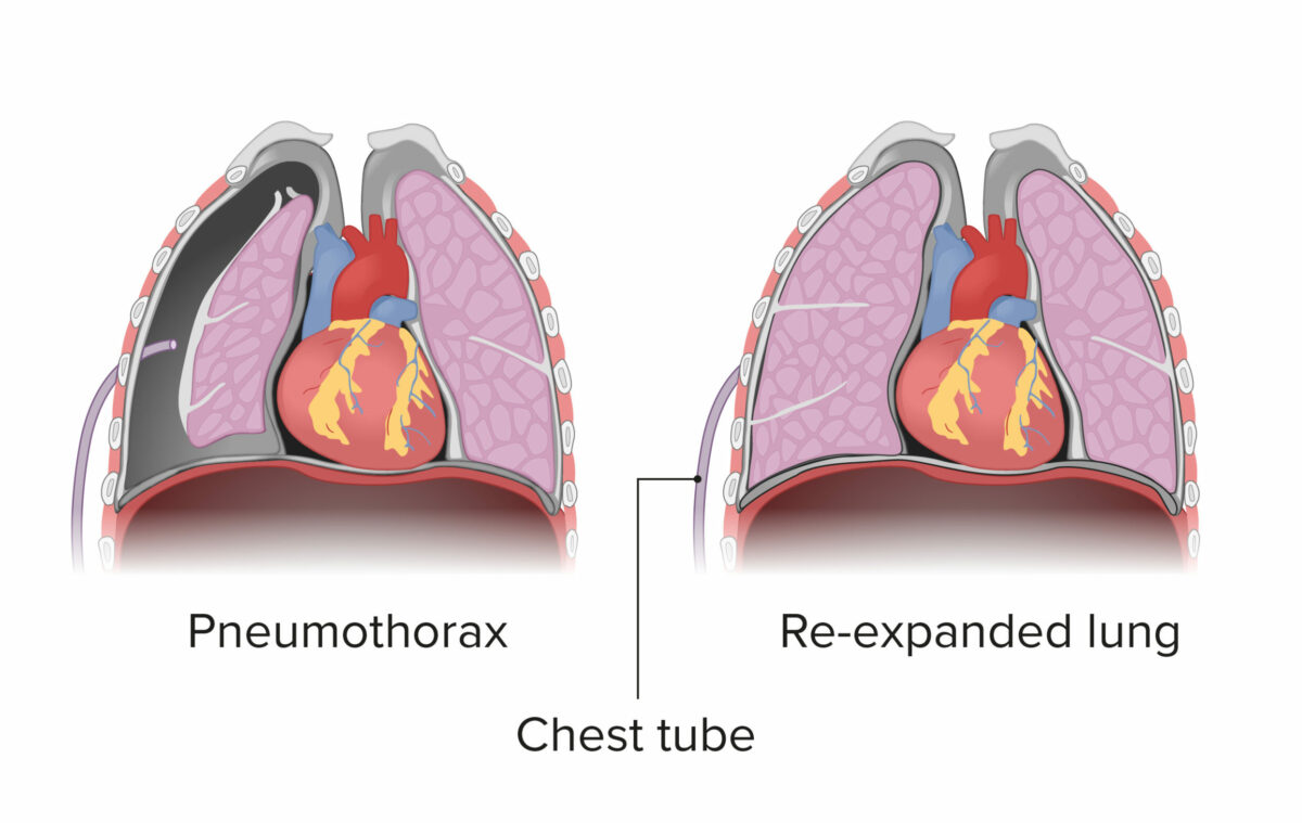 Chest tube placement into the chest and re-expansion of the lung