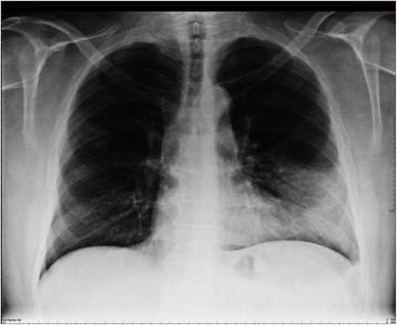 Chest x-ray dense infiltration