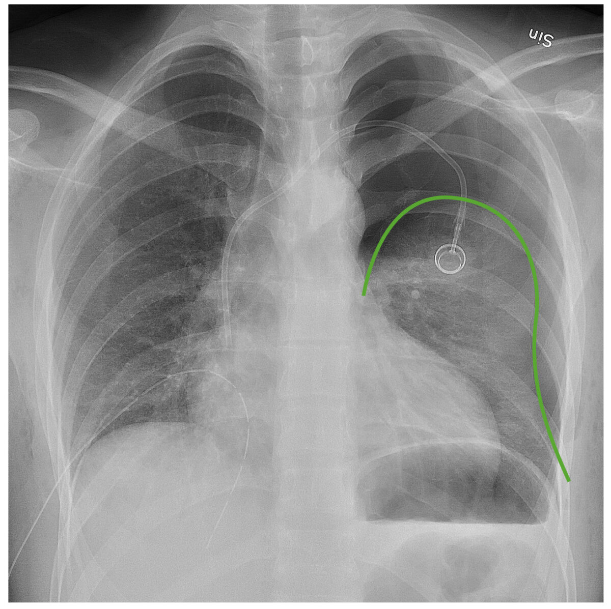 Chest x-ray showing left pneumothorax