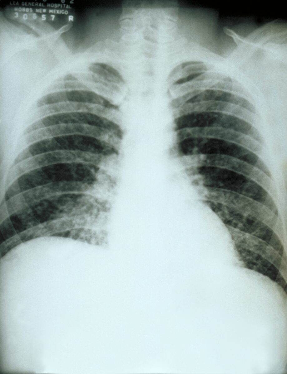 Chest_x-ray_acute_pulmonary_histoplasmosis