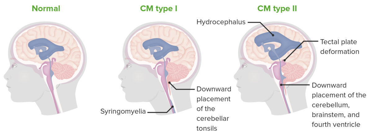 Malformaciones de chiari