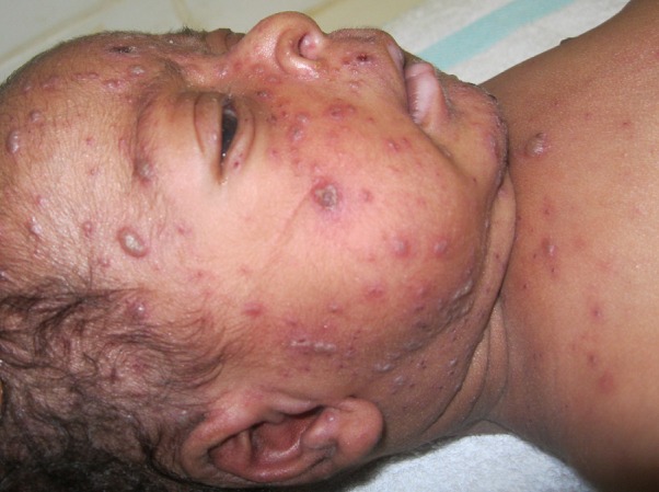 Chicken pox varicella zoster virus