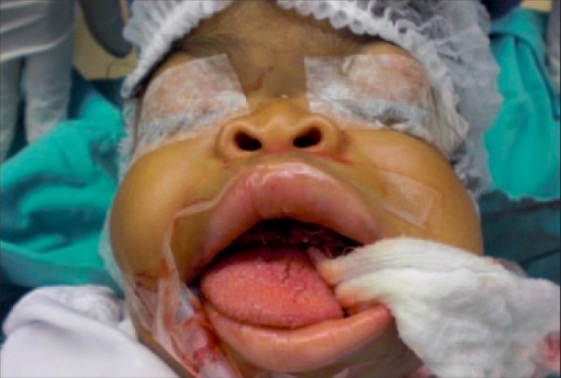 Child with i-cell disease