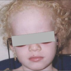 Child with albinism