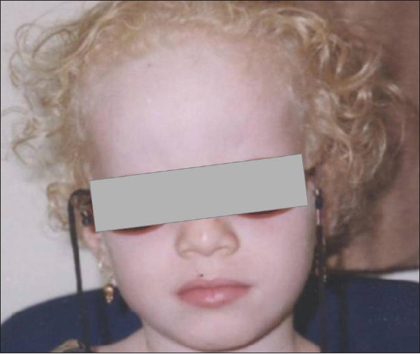 Criança com albinismo
