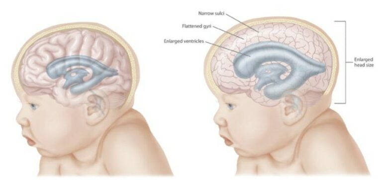 Hidrocefalia En Niños Concise Medical Knowledge 6513