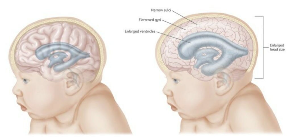 Child with hydrocephalus