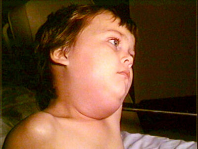 Child with mumps