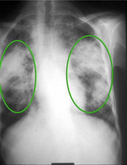 Childhood sarcoidosis on x-ray