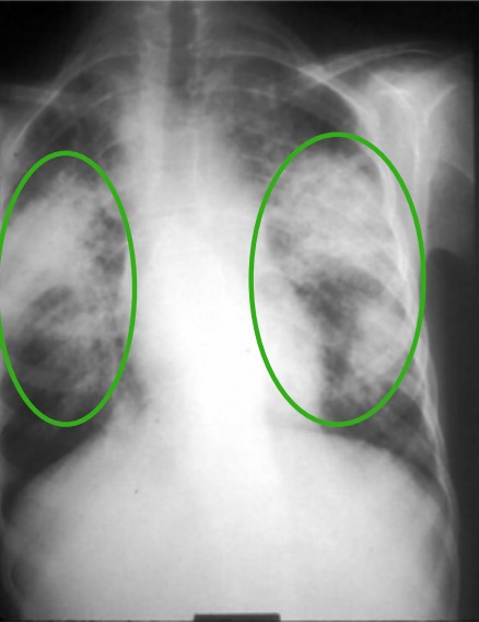 Sarcoidosis  Concise Medical Knowledge