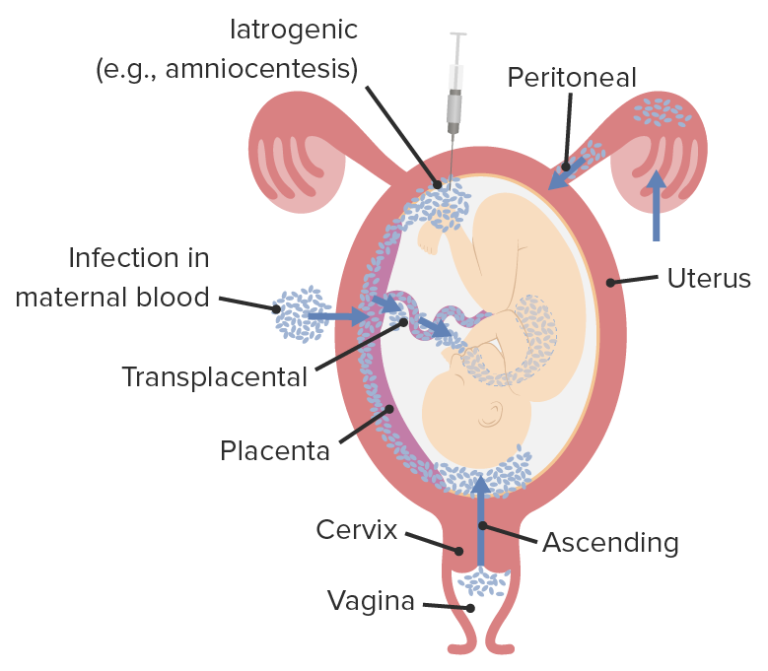 Chorioamnionitis | Concise Medical Knowledge