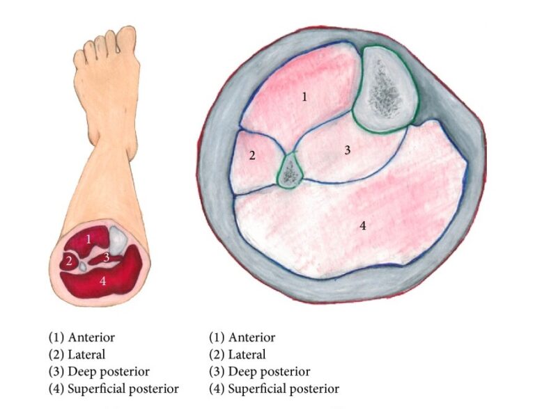 Compartment Syndrome Concise Medical Knowledge