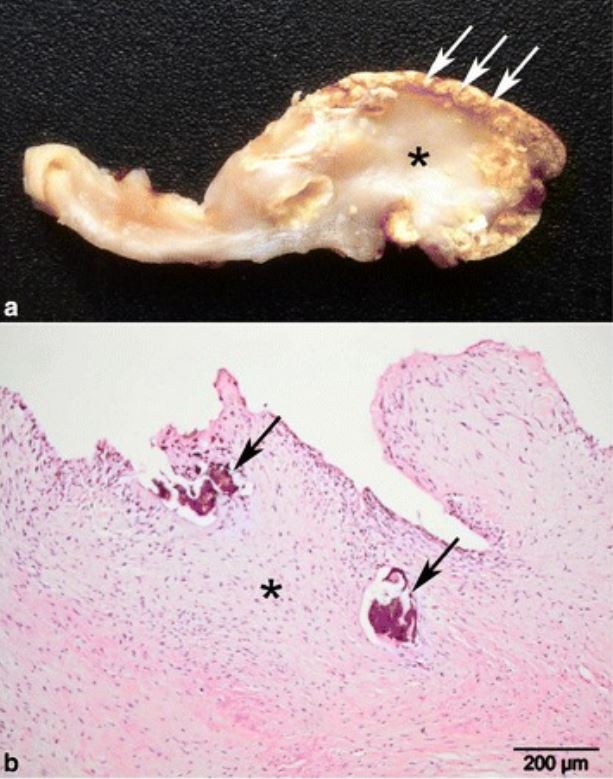 Chronic bovine fibrous calcified endocarditis pathologic specimens