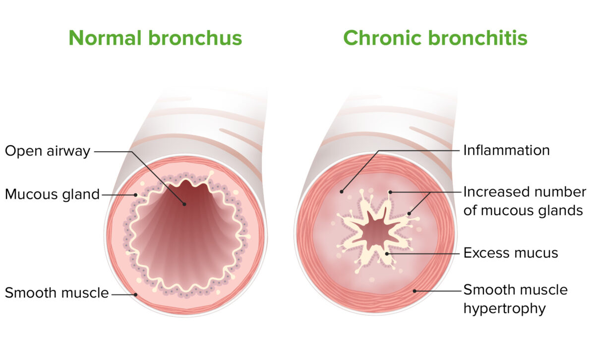 Chronic bronchitis pathophysiology