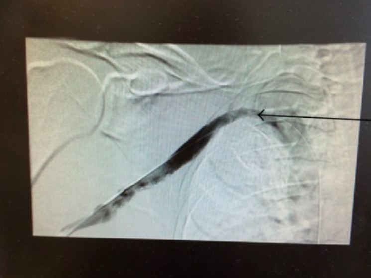 Chronic scarring of the right subclavian vein