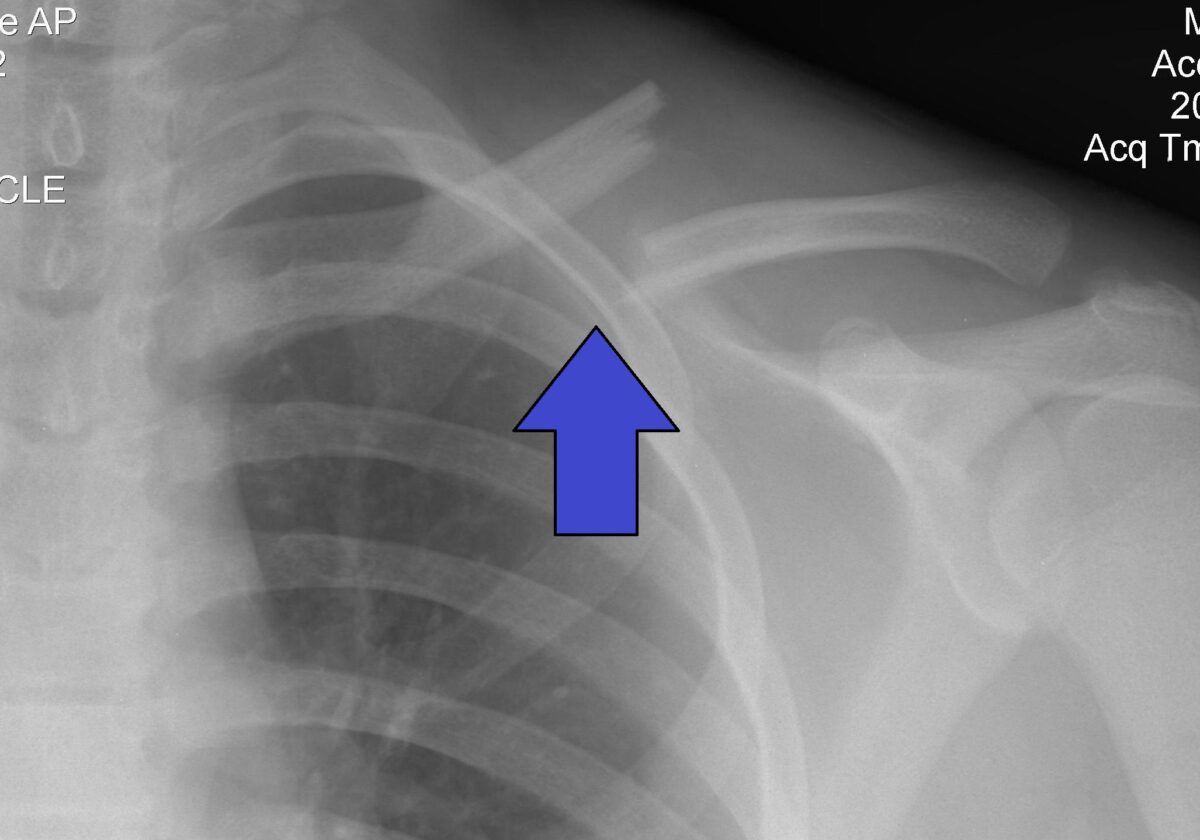 Clavicle fracture left